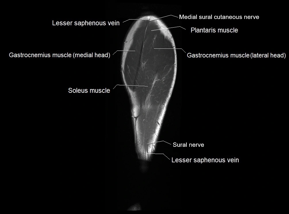 MRI 3T leg (tibia & fibula) labelled coronal cross sectional anatomy image 27.webp